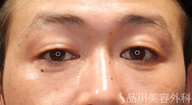 症例NO.74900のAFTER写真