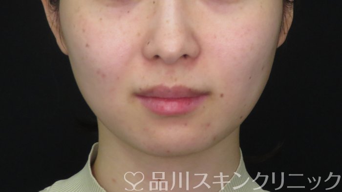 症例NO.72149のAFTER写真