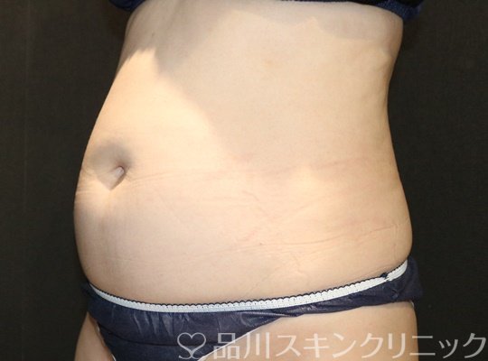 症例NO.70566のBEFORE写真