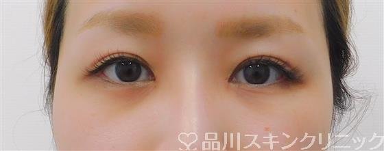 症例NO.42405のAFTER写真