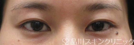 症例NO.60463のBEFORE写真