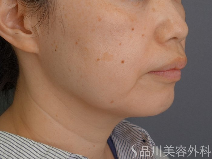 症例NO.74909のBEFORE写真