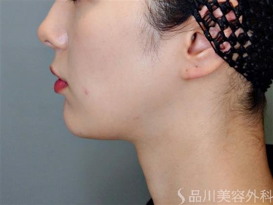 症例NO.50832のBEFORE写真