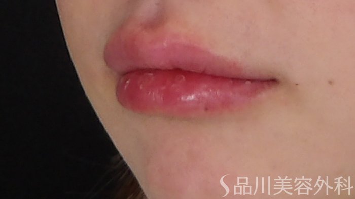 症例NO.67957のAFTER写真