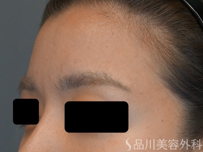 症例NO.74041のBEFORE写真