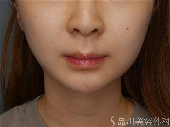 症例NO.59069のAFTER写真