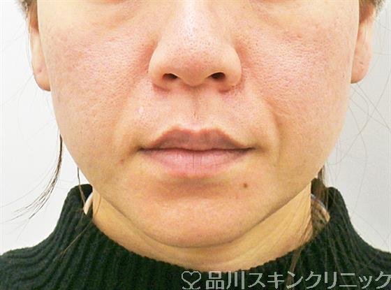 症例NO.26883のAFTER写真