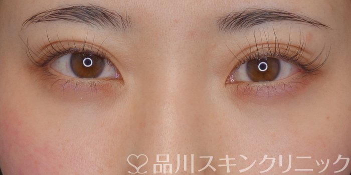 症例NO.74112のAFTER写真