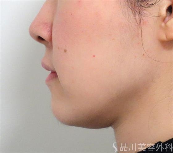 症例NO.38167のBEFORE写真