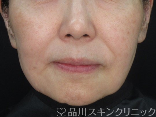 症例NO.73650のBEFORE写真