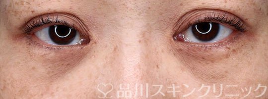 症例NO.65057のBEFORE写真