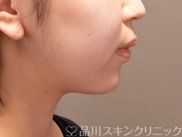 症例NO.70992のAFTER写真