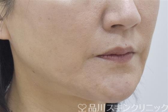 症例NO.53432のAFTER写真