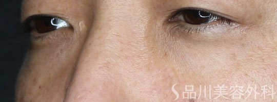 症例NO.72378のBEFORE写真