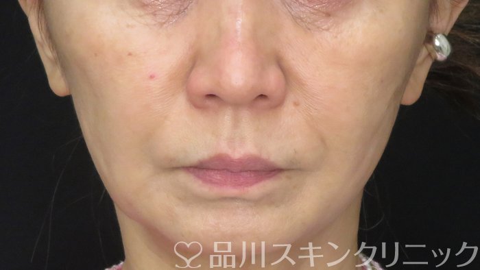 症例NO.70915のAFTER写真