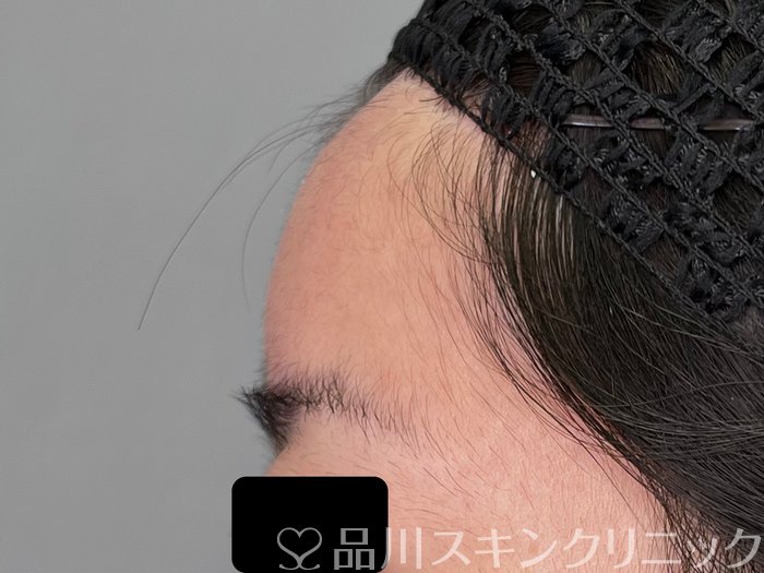 症例NO.70083のAFTER写真