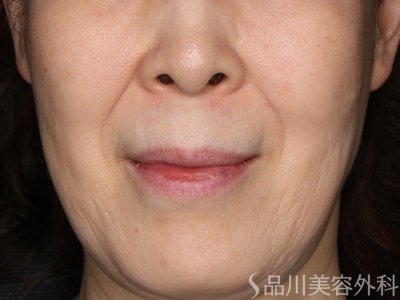 症例NO.75341のAFTER写真