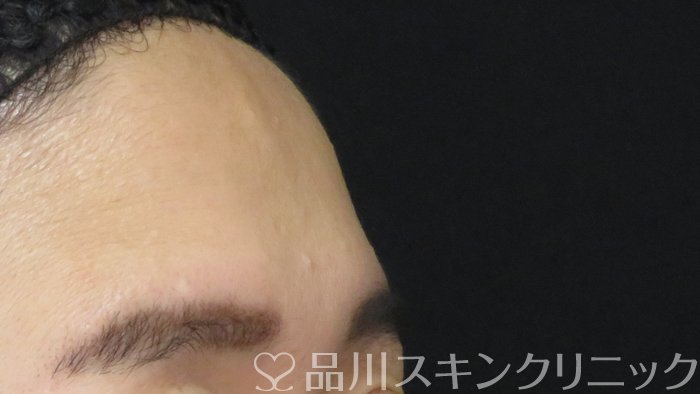 症例NO.72293のBEFORE写真