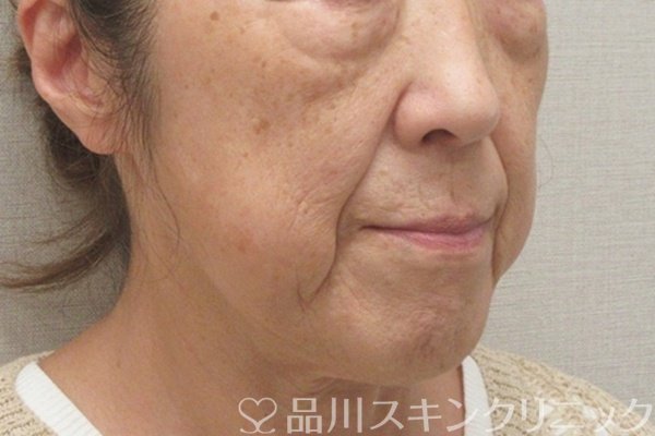 症例NO.75072のBEFORE写真