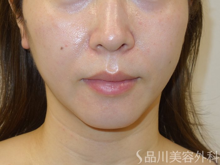 症例NO.73287のBEFORE写真