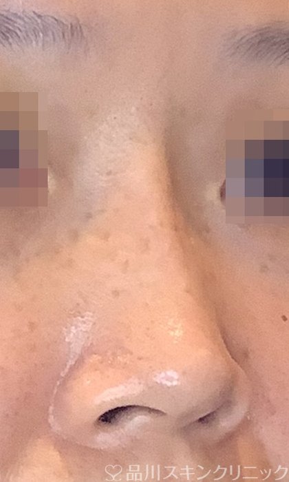 症例NO.74607のAFTER写真