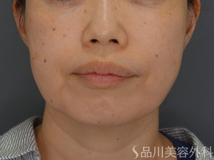 症例NO.74909のBEFORE写真