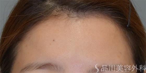 症例NO.51377のBEFORE写真