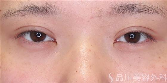 症例NO.47358のAFTER写真