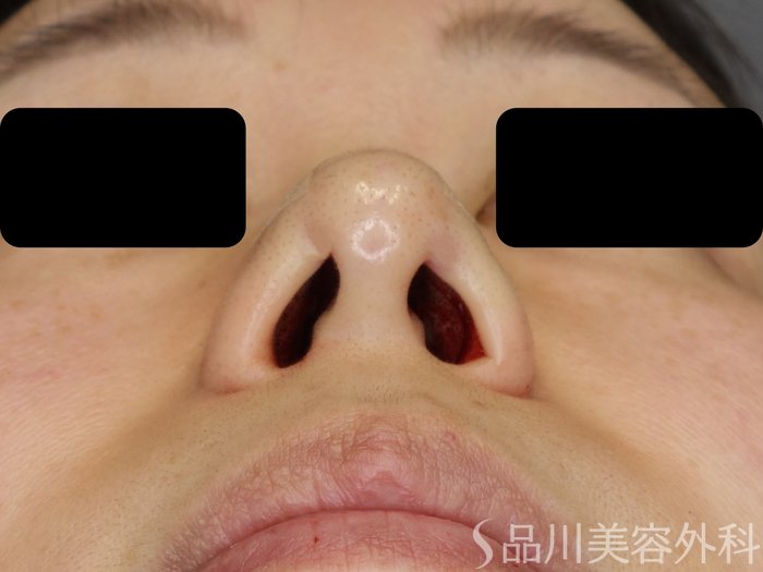 症例NO.72571のAFTER写真