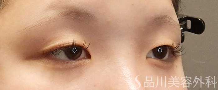 症例NO.69355のBEFORE写真