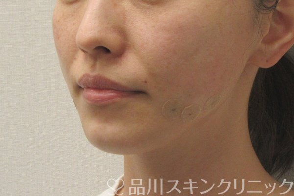 症例NO.74647のAFTER写真