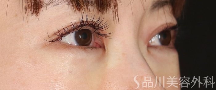 症例NO.72172のAFTER写真