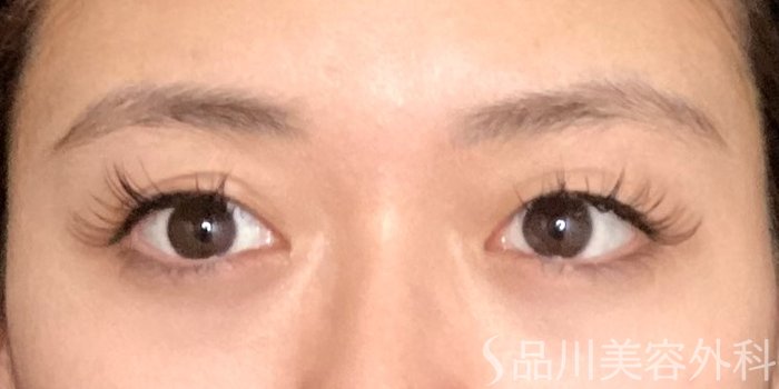 症例NO.65224のBEFORE写真