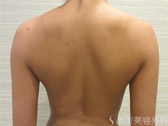 症例NO.23465のAFTER写真