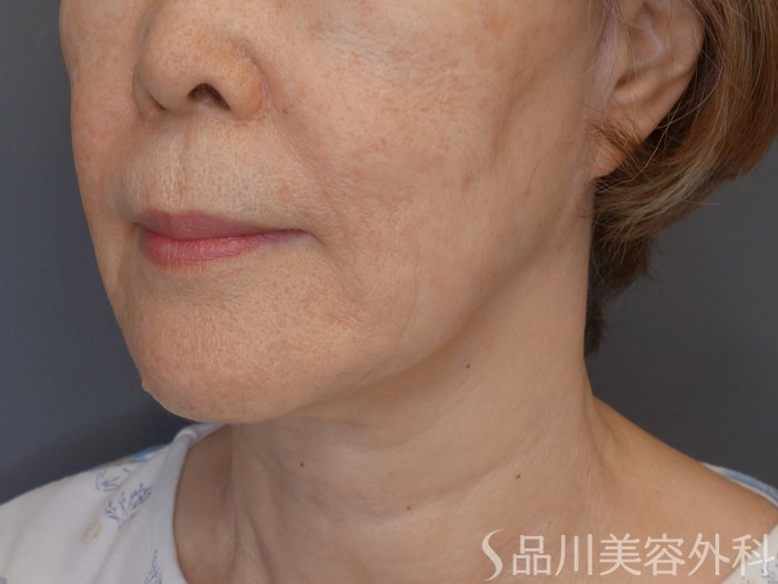 症例NO.71751のBEFORE写真