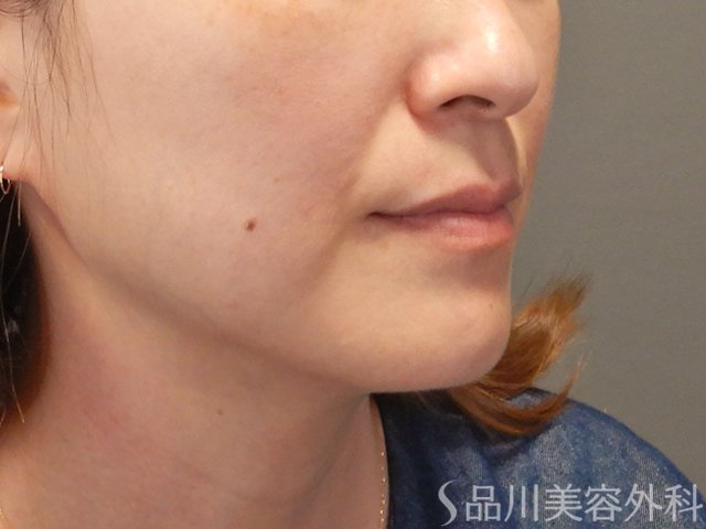 症例NO.74952のBEFORE写真