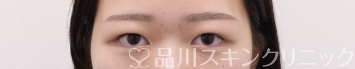 症例NO.69372のBEFORE写真