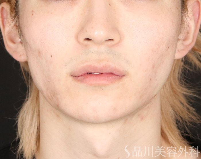 症例NO.73903のAFTER写真