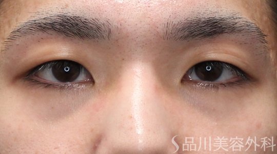 症例NO.74778のBEFORE写真