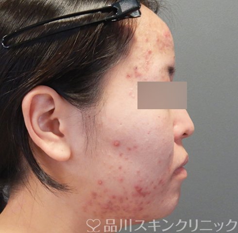 症例NO.70456のBEFORE写真