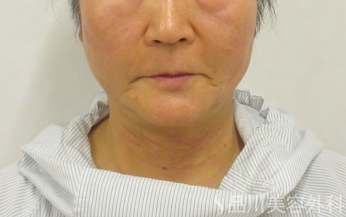 症例NO.72563のAFTER写真