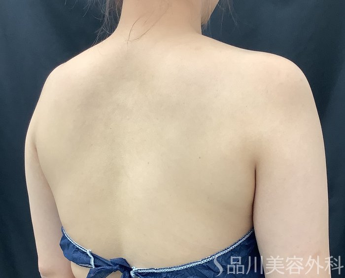 症例NO.67993のAFTER写真