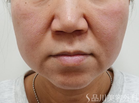 症例NO.73437のBEFORE写真