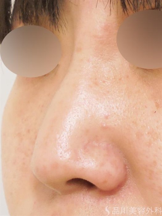 症例NO.27504のAFTER写真