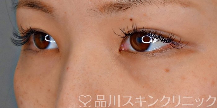 症例NO.73205のBEFORE写真