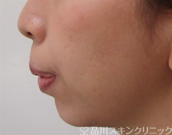 症例NO.39635のAFTER写真