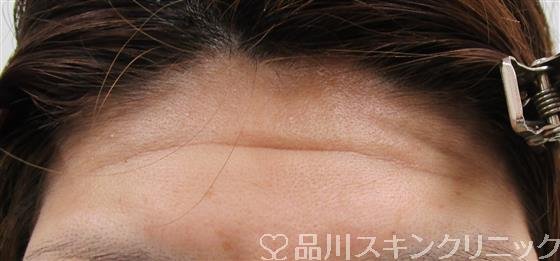 症例NO.43015のBEFORE写真