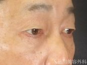 症例NO.74008のAFTER写真