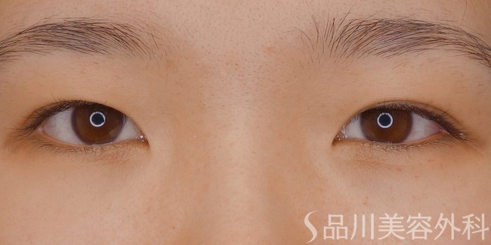 症例NO.70026のBEFORE写真