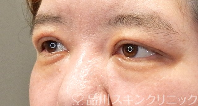 症例NO.64419のAFTER写真